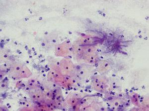 Citología (Papanicolaou, 20×) Actinomyces+vaginosis bacteriana.