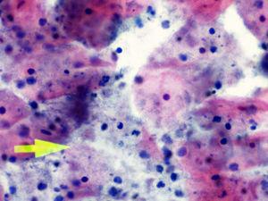 Citología (Papanicolaou, 40×) Actinomyces+Trichomonas (flecha) vaginosis bacteriana.