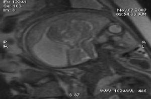 Resonancia magnética fetal. Corte sagital. Se observa tumoración en la línea media anterior, ventriculomegalia y compresión del parénquima sano por la tumoración.