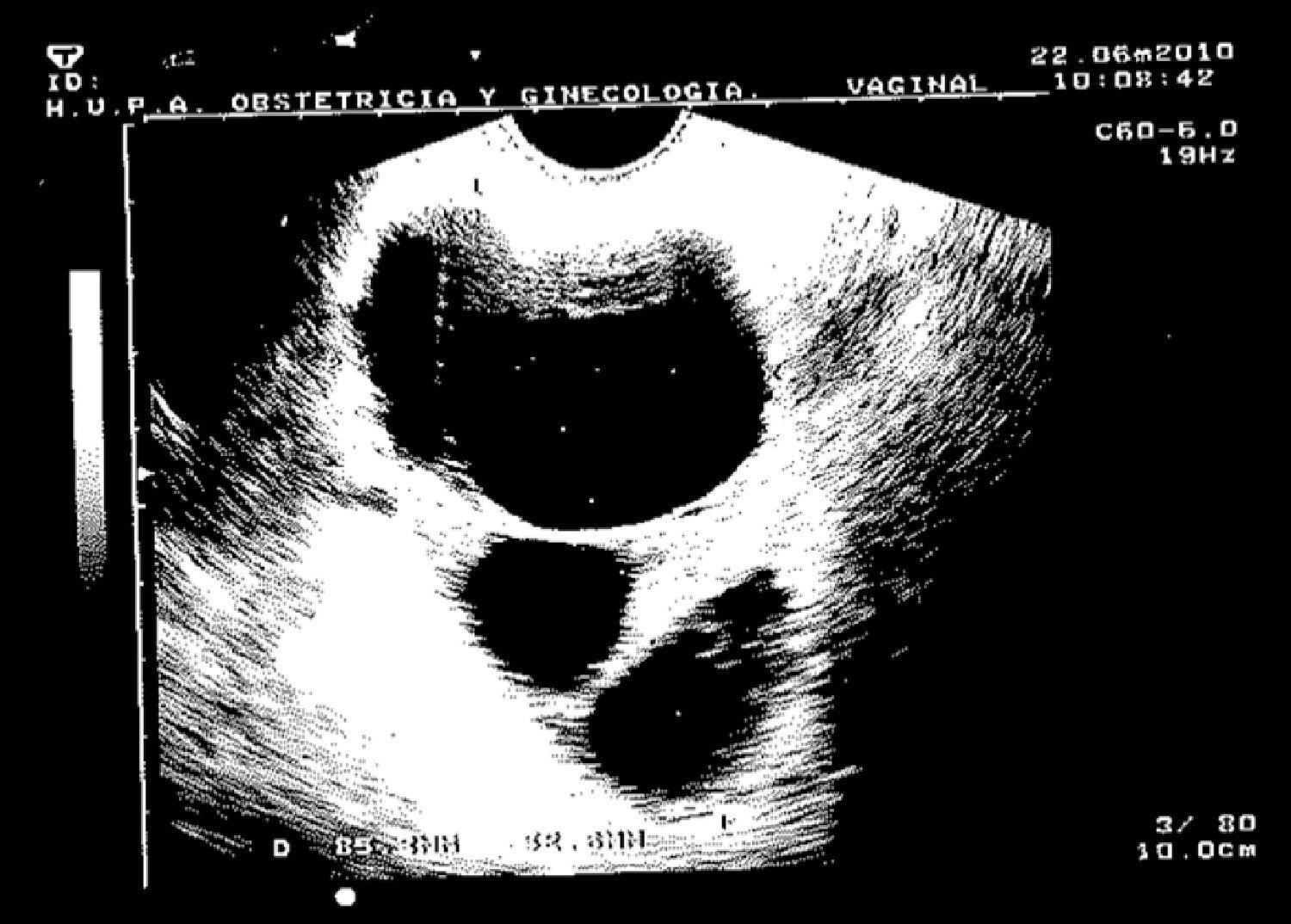 Precio tamoxifeno españa