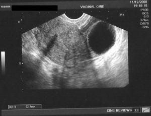 Caso número 4, edad: 41 años, quiste ovario izquierdo. Se aprecia el DIU intraútero.