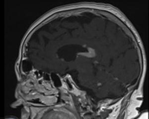 La RMN cerebral muestra imágenes hiperdensas a nivel ependimario-periventricular y cuerpo calloso compatible con linfoma cerebral primario. cerebral.