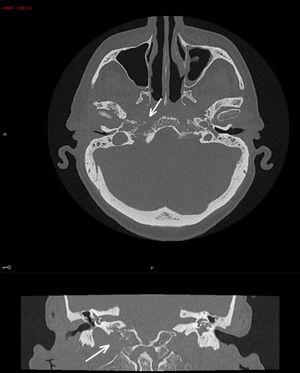 La primera imagen es una vista axial del TAC de mastoides. La flecha marca la erosión ósea sutil, que es nueva en comparación con el estudio anterior. El TAC en la vista reformada coronal, que muestra la pérdida de definición del borde basioccipital.
