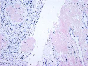 Biopsia renal (madre). Depósito masivo glomerular en córtex (izquierda) e intersticial en médula (derecha) (rojo Congo ×100).