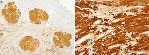 A)Biopsia renal (madre). Inmunohistoquímica para apoAI positiva en los depósitos glomerulares. B)Inmunohistoquímica para apoA1 positiva en los depósitos intersticiales de médula renal.