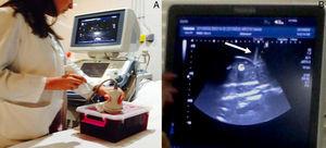 Modelo inanimado. A) Alumna biopsiando un riñón de silicona con control ecográfico. B) Visualización del riñón y de la aguja entrando al riñón de silicona señalado con una flecha (imagen en pantalla del ecógrafo).