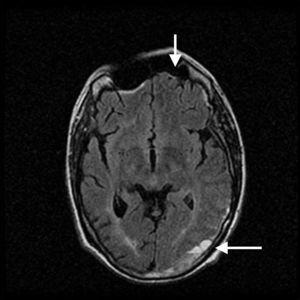 Imagen de angio-resonancia con las lesiones de isquemia (atrofia frontal, flecha) y hemorragia (región parietooccipital izquierda, flecha).
