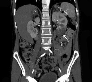 Corte coronal de TC con contraste mostrando un defecto de perfusión en el polo inferior del riñón izquierdo (flecha) correspondiente al área de infarto renal. La extensión de daño en este caso sería de 1/6 (17% del total del parénquima renal).