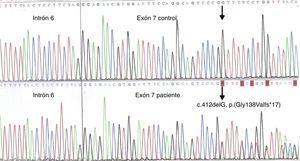 Gen COL4A5 con presencia de mutación no descrita previamente. El electroferograma muestra mutación truncante, con codón stop prematuro en posición 184, dando lugar a una proteína de tamaño anómalo (183 en lugar de 1.685 aminoácidos).