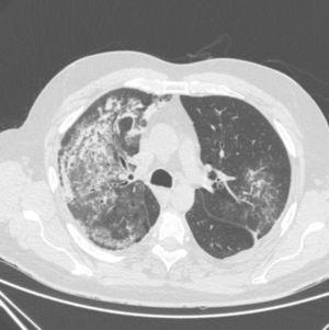 Imagen de TAC de tórax de alta resolución con hallazgo de un patrón alveolar compatible con hemorragia pulmonar.