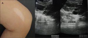 a) Lesión hipocrómica en forma de hoja de fresno en muslo izquierdo; b) La ecografía renal muestra aumento de volumen en ambos riñones y múltiples quistes bilaterales.