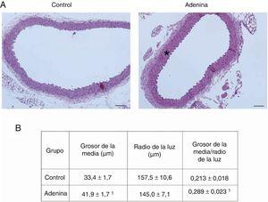 Los ratones con ERC inducida por dieta rica en adenina desarrollan daño estructural vascular. Los ratones fueron alimentados durante 6 semanas con la dieta estándar (Control) o con una dieta rica en adenina (Adenina). A) Las aortas fueron teñidas con hematoxilina-eosina. Se muestran cambios representativos. En los ratones Control no se aprecian lesiones. Obsérvese el engrosamiento de la media (asterisco) en las aortas de los ratones Adenina. Barra de escala: 100μm. Aumento ×20. B) Análisis morfométrico del grosor de la media y el radio de la luz, realizado mediante el software ImageJ y cálculo de su ratio. Se considera radio medio la media de 5 medidas independientes en distintas direcciones. Los valores se representan como la media±SEM. 1p<0,05 vs. Control. n=5 animales/grupo.