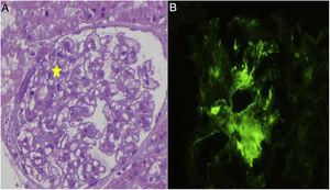 A) Biopsia renal, morfológicamente se observa un leve aumento de la celularidad mesangial en algunos glomérulos. B) Estudio de inmunofluorescencia directa donde se observan depósitos de C1q.