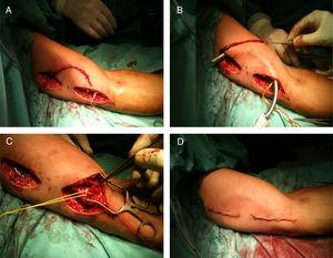 Procedimiento quirúrgico de implantación de una FAV nativa humerobasílica con superficialización y trasposición en un solo acto quirúrgico. Disección de la vena basílica mediante dos incisiones complementarias (A), tunelización en plano subcutáneo anterior (B), anastomosis arteriovenosa (C) y aspecto final tras cierre de heridas quirúrgicas (D).