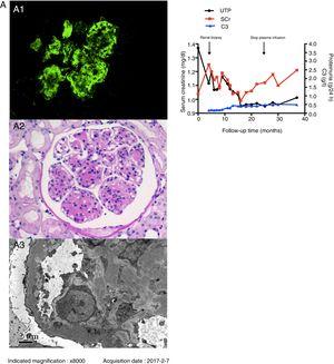 Renal biopsy findings of the patient. A1: Granular C3c deposition along the capillary wall and in the mesangium (indirect immunofluorescence staining on frozen tissue, 400×). A2: Severe mesangial proliferation and thickening of the glomerular capillary wall with double contour formation, giving the glomeruli a lobular appearance (Periodic acid staining, 400×). A3: Mesangial and subendothelial electron-dense deposits under EM (8000×). Fig. B. Schematic presentation of the patient's clinical course and treatment. Abbreviations: UTP: urine total protein excretion; SCr: serum creatinine; C3: complement 3.
