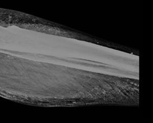 Radiografía de tobillo izquierdo usando la técnica de la mamografía. Evidencia de extensas calcificaciones vasculares en ramas principales (tibial posterior y peronea) y en arterias distales probablemente cutáneas, compatibles con sospecha de calcifilaxis.