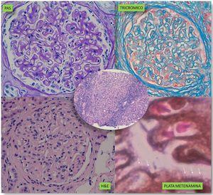 Imágenes de microscopia óptica de biopsia renal.
