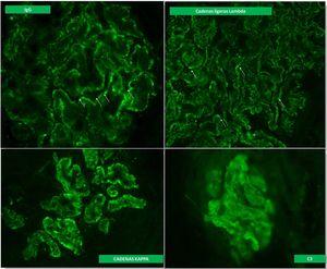 Imágenes de inmunofluorescencia directa de biopsia renal.