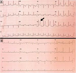 A) Electrocardiograma en el momento del desarrollo de dolor torácico, mostrando descenso generalizado del segmento PR, y ascenso del segmento ST en V3-V5. B) Electrocardiograma al alta, con resolución de las alteraciones previas.