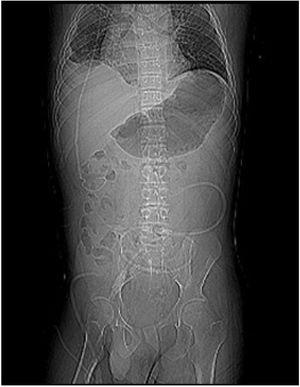 Sección torácica y abdominal de la derivación ventrículo-peritoneal, sonda Foley insertada en la apendicovesicostomía de Mitrofanoff y el catéter de diálisis peritoneal de Tenckhoff.
