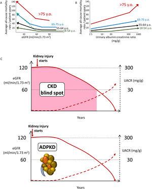 Chronic kidney disease (CKD) is associated with an increased risk of death even in the very elderly. All-cause mortality rate (absolute risk) for different eGFR (A) and UACR (B) values by age categories based on weighted average across cohorts, adjusted for covariates. A steeper slope at older age indicates a higher absolute risk difference associated with low eGFR as compared with younger age categories: the discontinuous green line represents the overlay of the risk for the very elderly on top of the risk line for the younger age range. Similar trends were observed for albuminuria. Conceptual representation of data presented in 5. In panel A, an increase in the risk of death observed in patients older than 55 years with higher eGFR values is not shown as this is thought to be an artifact depending on lower muscle mass of patients who were sicker at baseline. (C) The blind spot in CKD, as illustrated by autosomal dominant polycystic kidney disease. In ADPKD, CKD is present from birth, but using conventional criteria to diagnose CKD as low eGFR or pathological albuminuria, it can only be diagnosed 30–40 years later. However, there is a diagnostic test, sonography, that allows a much earlier diagnosis by demonstrating the presence of kidney cysts. Diagnostic tests should be developed that allow to diagnose CKD from other, non-ADPKD, causes decades earlier than current GFR or albuminuria criteria allow (figure from ref. 13). Reproduced from 1.