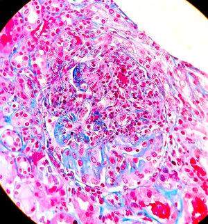 Microscopía óptica (20x). Tinción Hematoxilina-Eosina muestra glomérulo con semiluna epitelioide colapsando el penacho glomerular.