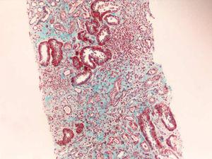 Tricrómico de Masson ×100: intersticio con abundante fibrosis, atrofia tubular, daño tubular agudo con regeneración e infiltrado inflamatorio crónico.