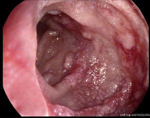 Se observa «pars descendens» duodenal con mucosa granular y friable en relación con vasculitis secundaria a PSH como causa de hemorragia digestiva alta.
