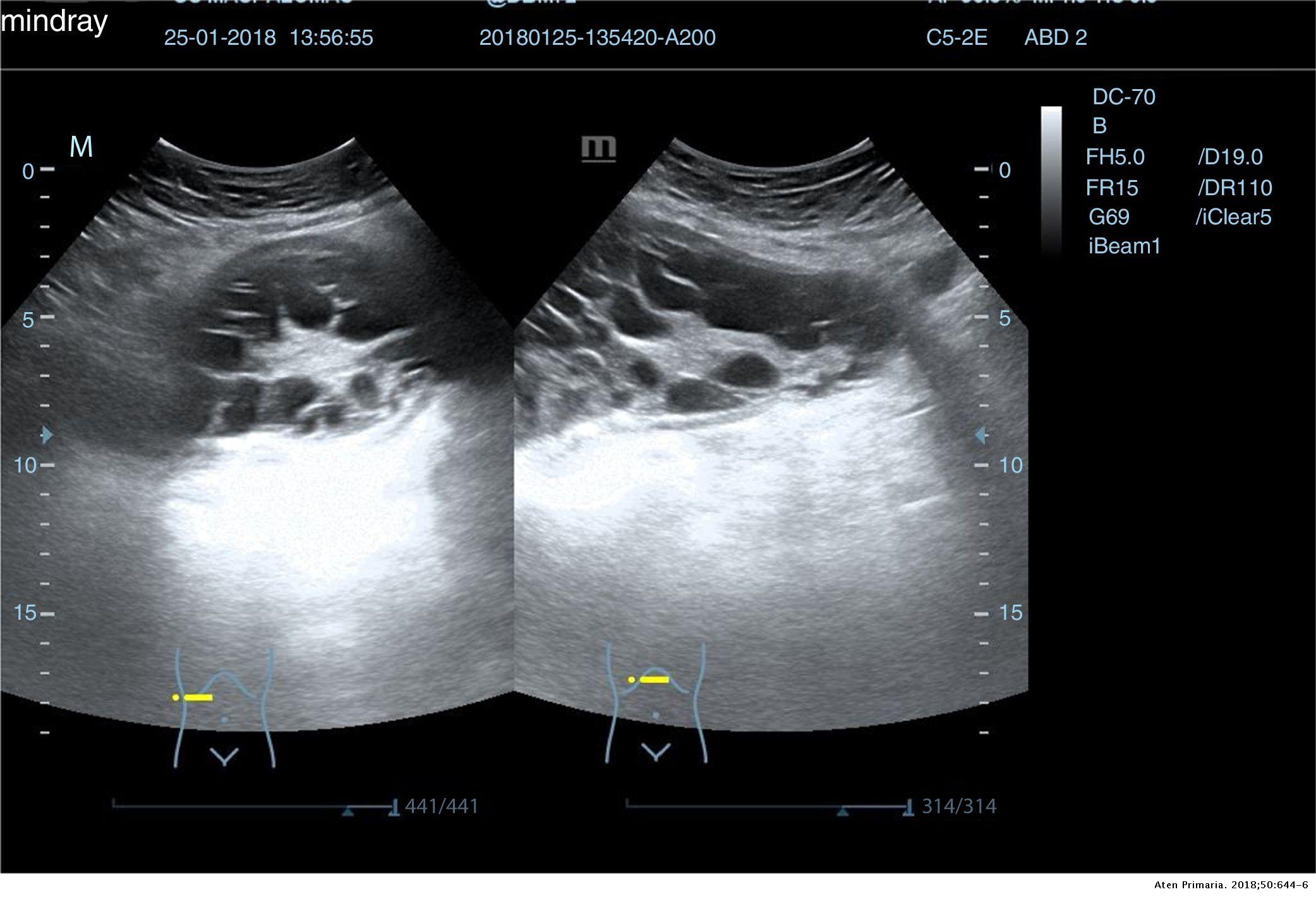 La importancia de la ecografía abdominal en el manejo de tumoraciones  abdomino/pélvicas en atención primaria | Atención Primaria