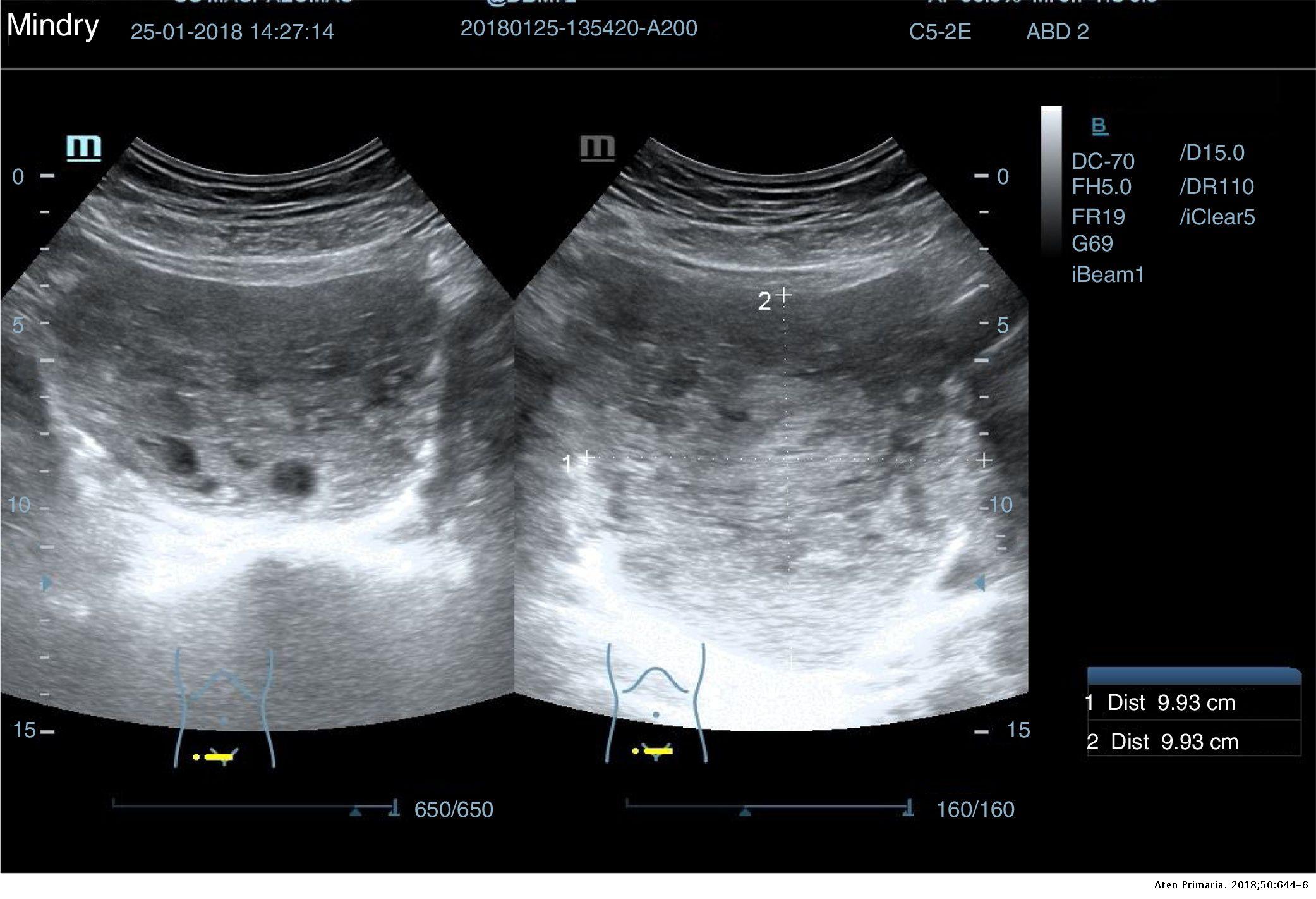 La importancia de la ecografía abdominal en el manejo de tumoraciones  abdomino/pélvicas en atención primaria | Atención Primaria