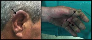 Acrodermatitis que afecta a pabellones auriculares, manos y uñas.