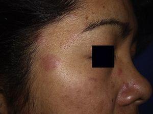 Detalle del aspecto inflamatorio en una de las lesiones faciales.