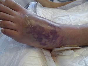 Lesión del pie izquierdo con desarrollo de livedo reticularis.