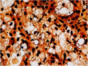 Warthin-Starry: presencia de abundantes bacilos en el seno de macrófagos espumosos (células de Mikulicz).