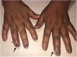 Eritema violáceo en 3.er dedo de mano izquierda y porción distal de 4.o dedo de mano derecha (flechas), con leve edema asociado. En cara lateral de 4.o dedo de mano derecha puede observarse la puerta de entrada (asterisco).