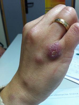 Lesión nodular ulcerada de inoculación de borde neto y cubierta por una costra. Tres nódulos en el dorso de la mano y en la muñeca derecha.