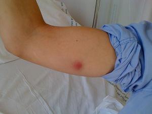 Nódulo satélite linfático doloroso, en la cara interna de brazo derecho con signos inflamatorios.