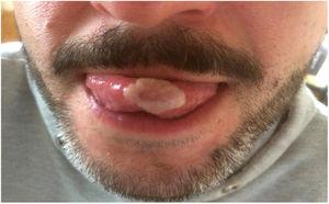 Lesión blanquecina en la punta de la lengua.