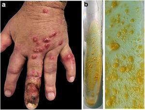 (a) Clinical image: disseminated cutaneous papules distributed in a sporotrichoid pattern on the back of the left hand. (b) Culture: typical photochromogenic colonies of Mycobacterium marinum on Löwenstein-Jensen medium.