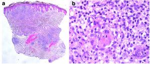 Histopathological features: (a) intradermal nodular inflammatory infiltrate covered by hyperplastic epidermis (hematoxylin and eosin; ×16); (b) dermal epithelioid granulomas without central necrosis surrounded by lymphoplasmacytic infiltrate (hematoxylin and eosin; ×400).