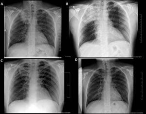 Radiological evolution. (A) At emergency room; (B) 48h post admission; (C) just before patient's discharge; (D) 2 months after hospitalization.