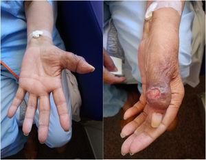 Tumefacción y ulceración cutánea en primer dedo de la mano.