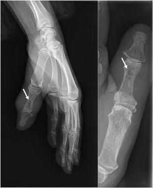 Lesión osteolítica en falange proximal del primer dedo de la mano.