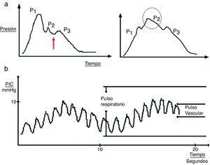 a) Detalle de la onda cardíaca de la presión intracraneal (PIC). En la gráfica de la izquierda se puede observar un registro no patológico; la flecha indica la hendidura dícrota. En la gráfica de la derecha destaca cómo la onda P2 se acentúa en situaciones de baja distensibilidad. b) Patrón ondulatorio de la onda de PIC.