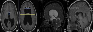 Preoperatorio, (A y B) resonancia magnética (RM) cerebral en T1 sin contraste que mostró hidrocefalia triventricular. Índice de Evans de 0.43 (B). Diámetro del iii ventrículo>1,4cm (A); preoperatorio (C), RM en T2, que mostró aumento de la convexidad del cuerpo calloso, aplanamiento del mesencéfalo y estenosis del acueducto de Silvio; posoperatorio (D), RM en T1 sin contraste, donde se evidenció la disminución de la talla ventricular, elevación del mesencéfalo y el trayecto para la tercer-ventriculostomía endoscópica.