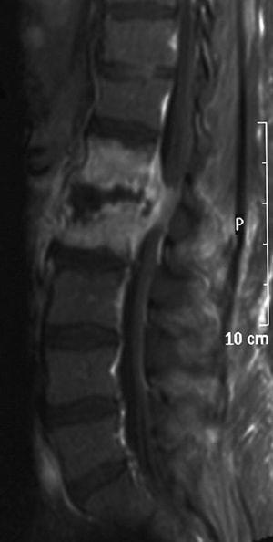 Espondilodiscitis L1-L2 por S. agalactiae con absceso epidural y compresión medular. Resonancia magnética espinal sagital, secuencia ponderada en T1, tras inyección de gadolinio.