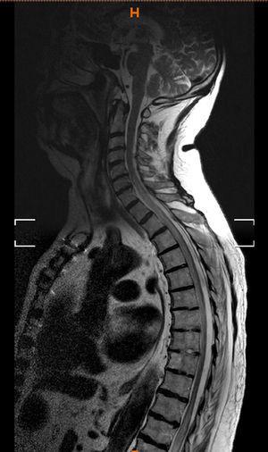RMN de columna: corte sagital que evidencia una lesión isquémica extensa medular.