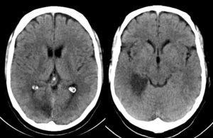 TC cerebral. Hipodensidad en territorio de ramas perforantes talámicas dorsolaterales y temporooccipital de la arteria cerebral posterior derecha.