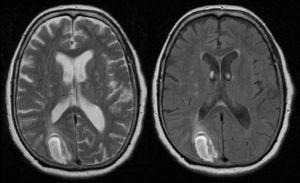 RMN cerebral. Lesión hiperintensa en T2 y FLAIR en su periferia relacionada con hemorragia intraparenquimatosa de distribución corticosubcortical occipital derecha.