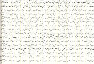 EEG de 16 canales de la paciente, que muestra enlentecimiento generalizado de la actividad de fondo con ondas trifásicas generalizadas durante todo el registro.